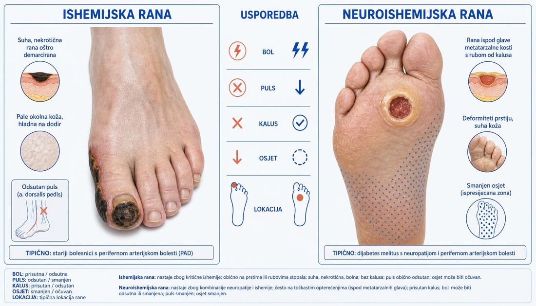 Usporedni prikaz ishemijske i neuroishemijske rane stopala: suha, oštro demarcirana nekroza na prstu s hladnom blijedom kožom prema rani ispod glave metatarzalne kosti s rubom kalusa i zonom smanjenog osjeta.
