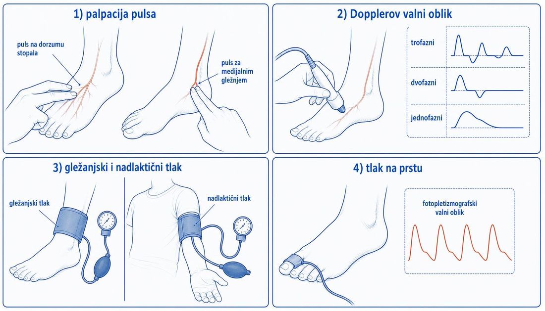 Shema u četiri polja: palpacija pulsa na dorzumu stopala i za medijalnim gležnjem, Dopplerov valni oblik s trofaznim, dvofaznim i jednofaznim signalom, mjerenje gležanjskog i nadlaktičnog tlaka te tlak na prstu s fotopletizmografskim zapisom.