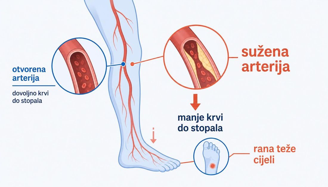 Jednostavan prikaz noge s otvorenom i suženom arterijom te strelicom koja pokazuje da do stopala dolazi manje krvi, pa rana teže cijeli.