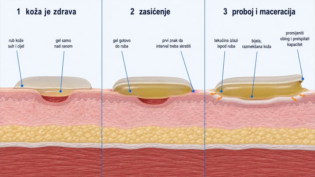Shema stanja periulkusne kože pod hidrokoloidnom pločom u tri prikaza