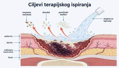 Presjek kronične rane s prikazom ciljeva terapijskog ispiranja: mlaz otopine odnosi nevezane nečistoće, eksudat i površinski biofilm, uz označene slojeve epidermisa, dermisa, potkožnog masnog tkiva i fascije.