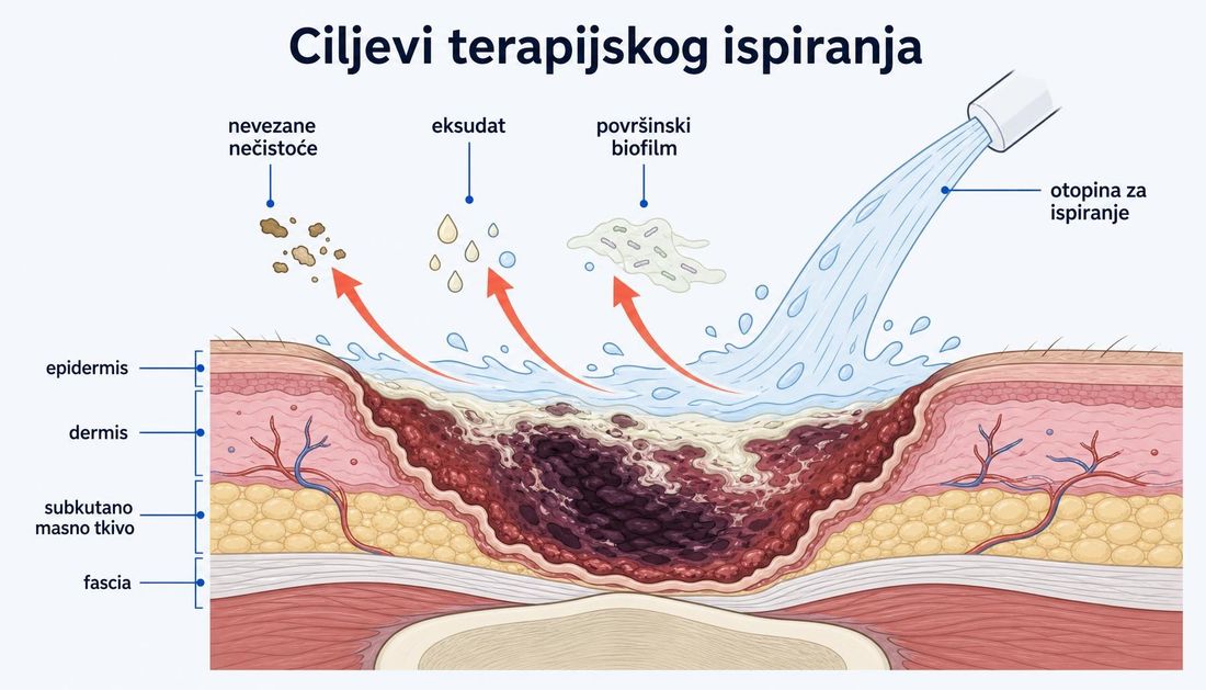 Presjek kronične rane s prikazom ciljeva terapijskog ispiranja: mlaz otopine odnosi nevezane nečistoće, eksudat i površinski biofilm, uz označene slojeve epidermisa, dermisa, potkožnog masnog tkiva i fascije.