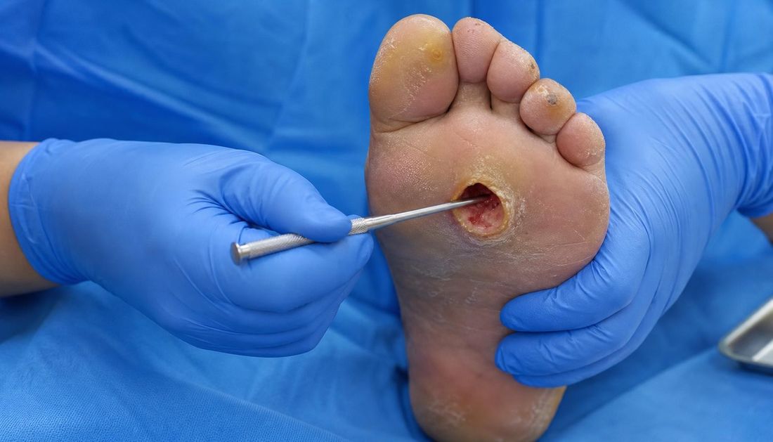 Fotorealističan prikaz izvođenja testa dodirom kosti: sterilna tupa metalna sonda uvodi se pod malim kutom u duboki tabanski ulkus dok druga ruka u rukavici pridržava stopalo.