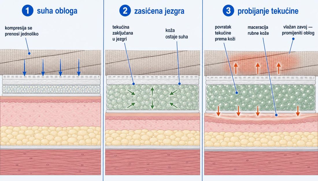 Shema u tri jednaka poprečna prikaza iste potkoljenice pod kompresijskim zavojem, bez deformacije anatomije. U prvome prikazu obloga je suha i kompresija se prenosi jednoliko prema koži. U drugome je jezgra zasićena, tekućina ostaje zaključana u jezgri, a koža ispod obloge ostaje suha. U trećem je kapacitet prekoračen, tekućina se vraća prema koži, zavoj je vlažan i vidljiva je maceracija rubne kože, što je znak da oblog treba promijeniti ili sustav prilagoditi.