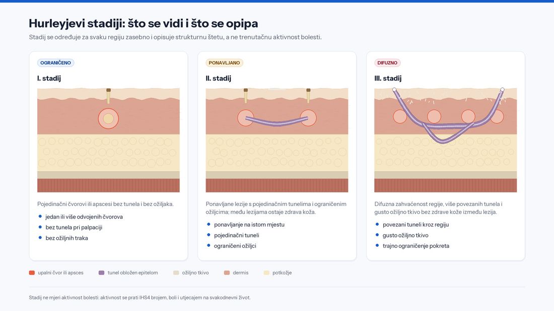 Tri panela s presjekom kože: pojedinačni čvor bez tunela, odvojene lezije s tunelima i ožiljcima te difuzno zahvaćeno područje s povezanim tunelima