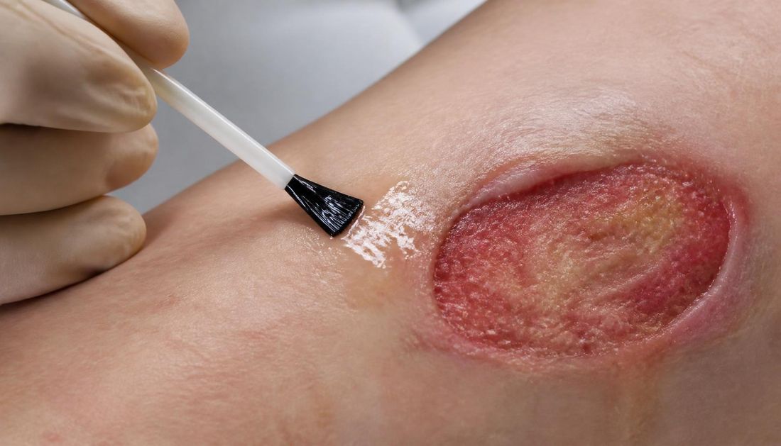Protecting the periwound skin with a transparent barrier film before applying a new dressing