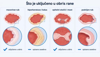Shema u četiri panela s uvećanim detaljem ruba rane: maceriran rub, hiperkeratoza i kalus, epitelni otočić i most te podvijen rub, uz oznaku je li nalaz uključen u obris ili se opisuje zasebno.