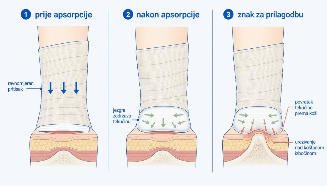 Shema obloge ispod kompresijskoga zavoja u tri stanja: tanka obloga prije apsorpcije, nabubrila jezgra nakon apsorpcije i stanje u kojemu se tekućina vraća prema koži uz vidljivo urezivanje nad koštanom izbočinom.