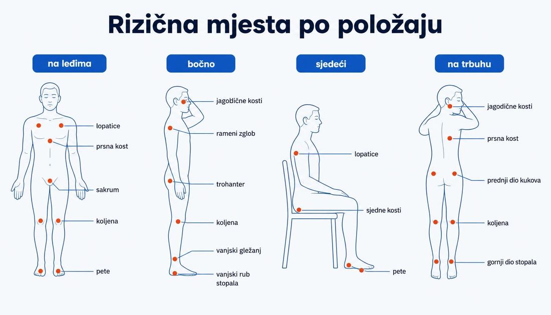 Četiri tjelesne siluete u položaju na leđima, bočno, sjedeći i na trbuhu s označenim rizičnim koštanim izbočinama.