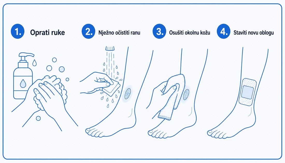 Jednostavna ilustracija u četiri koraka za pacijente: oprati ruke, nježno očistiti ranu, osušiti okolnu kožu i staviti novu oblogu.