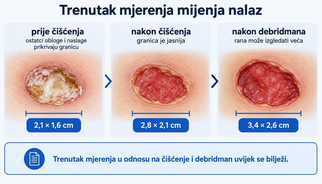 Tri panela iste rane: prije čišćenja s naslagama koje prikrivaju granicu, nakon čišćenja s jasnijom granicom i nakon debridmana kada rana može izgledati veća, uz pripadajuće dimenzije.