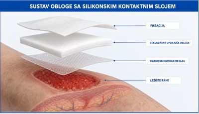 Rastavljeni prikaz sustava obloge iznad rane: ležište rane, silikonski kontaktni sloj s perforacijama, sekundarna upijajuća obloga i vanjska fiksacija, svaki sloj označen hrvatskim nazivom.