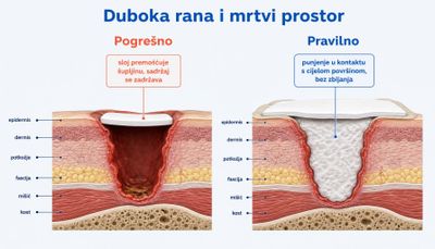 Dva presjeka duboke rane s prikazom mrtvoga prostora: lijevo kontaktni sloj premošćuje šupljinu i sadržaj se zadržava u dubini, desno je šupljina rahlo ispunjena materijalom u kontaktu s cijelom površinom rane.