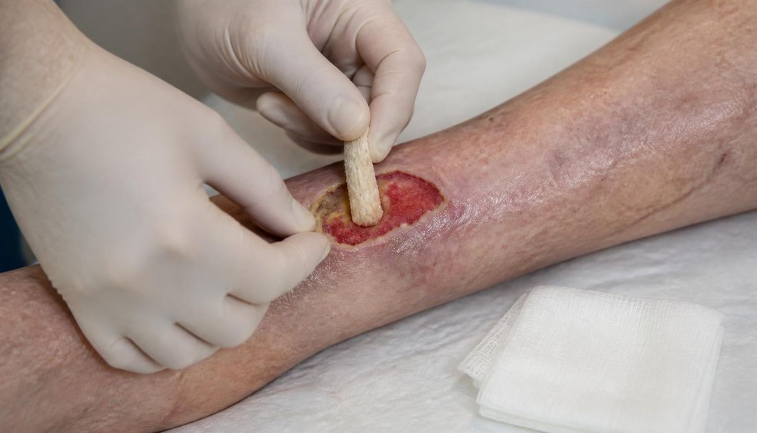 A haemostatic alginate dressing applied to a bleeding wound to support haemostasis
