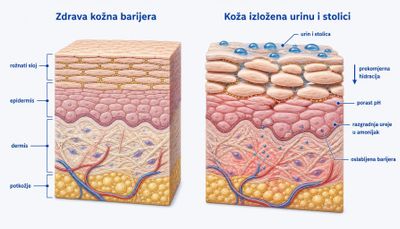 Usporedni presjek kože: zdrava barijera s čvrsto poredanim korneocitima i lipidima te koža izložena urinu i stolici s nabujalim korneocitima, porastom pH i razgradnjom ureje u amonijak.