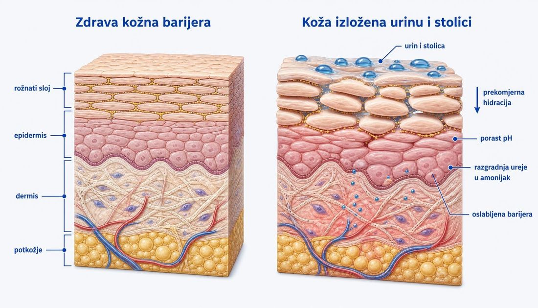 Usporedni presjek kože: zdrava barijera s čvrsto poredanim korneocitima i lipidima te koža izložena urinu i stolici s nabujalim korneocitima, porastom pH i razgradnjom ureje u amonijak.