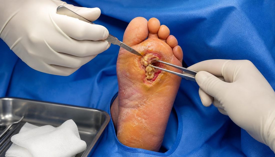 Fotorealističan prikaz kontrole izvora infekcije u sterilnim uvjetima: kirurg u rukavicama skalpelom i pincetom otvara i čisti inficirani tabanski prostor stopala uz sterilne kobaltne kompese i instrumentarij.
