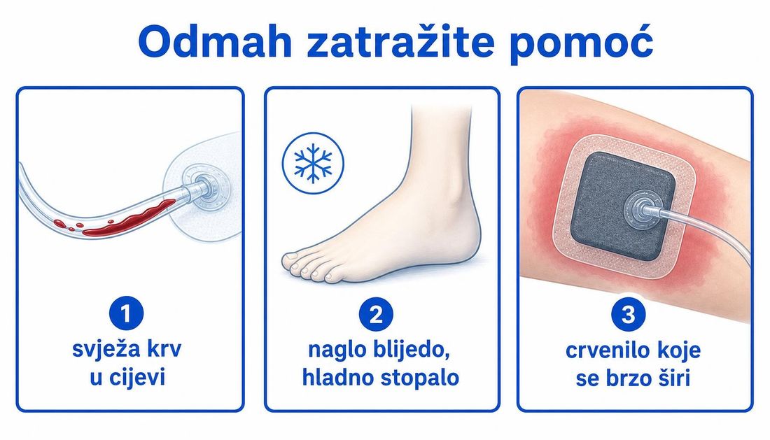 Pojednostavljena shema s tri znaka za hitno javljanje: svježa krv u cijevi, naglo blijedo i hladno stopalo te crvenilo koje se brzo širi.