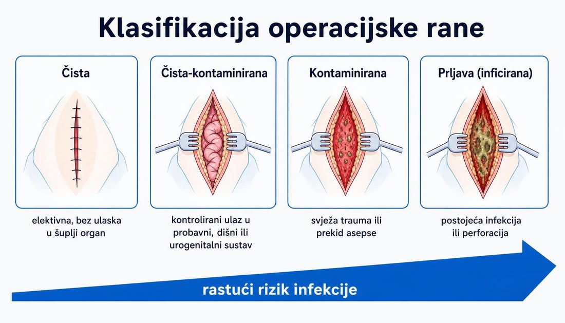 Shema četiriju klasa operacijske rane s hrvatskim oznakama: čista, čista-kontaminirana, kontaminirana i prljava odnosno inficirana rana, uz strelicu rastućega rizika infekcije.
