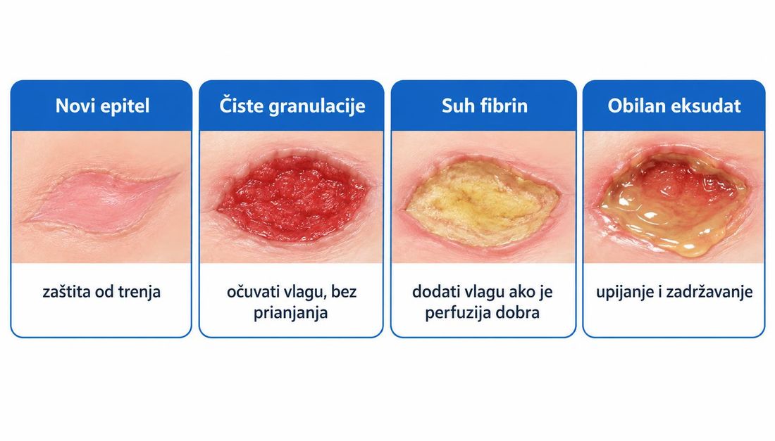 Shematski prikaz četiriju ležišta rane: novi epitel traži zaštitu od trenja, čiste granulacije očuvanje vlage bez prianjanja, suhi fibrin dodatak vlage uz dobru perfuziju, obilan eksudat upijanje i zadržavanje