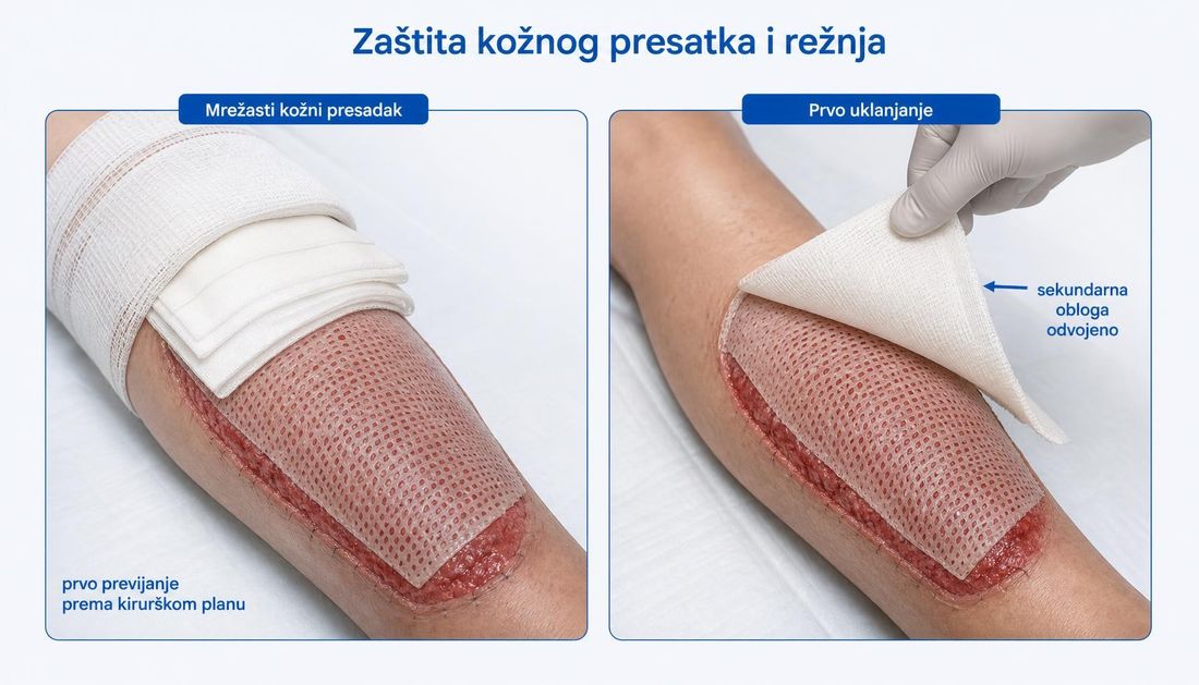 Mrežasti kožni presadak na potkoljenici prekriven tankim perforiranim kontaktnim slojem i upijajućom oblogom te prikaz prvoga uklanjanja u kojem se odvaja samo sekundarna obloga, a kontaktni sloj ostaje na presadku.