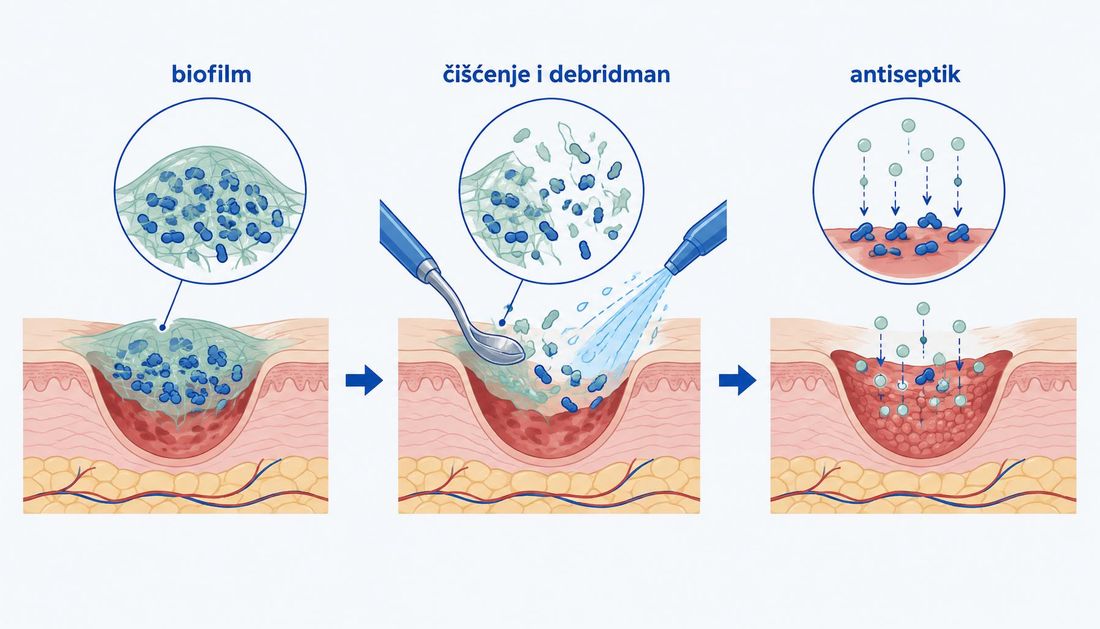 Shema u tri koraka: biofilm kao zaštitna izvanćelijska matrica nad kolonijama bakterija u rani, zatim čišćenje i debridman kiretom i ispiranjem koji razaraju matricu, i na kraju antiseptik koji dolazi do izloženih bakterija.