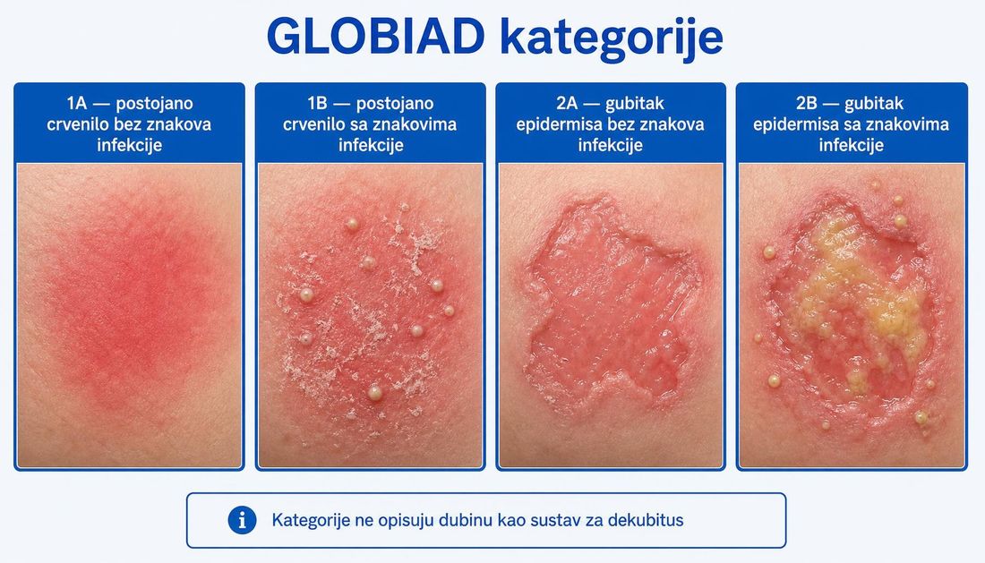 Četiri panela s prikazom GLOBIAD kategorija: 1A postojano crvenilo bez znakova infekcije, 1B crvenilo sa satelitskim pustulama, 2A gubitak epidermisa bez znakova infekcije i 2B gubitak epidermisa sa znakovima infekcije.