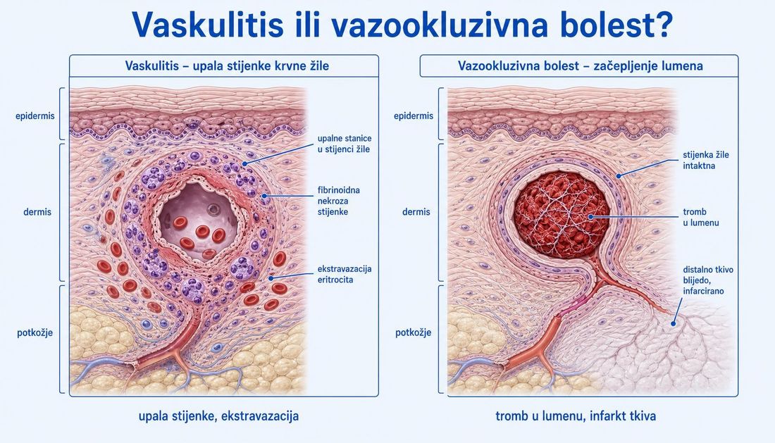 Dva usporedna presjeka kože s uvećanom sitnom krvnom žilom: lijevo vaskulitis s upalnim stanicama u stijenci, fibrinoidnom nekrozom i izlaskom eritrocita u okolno tkivo, desno vazookluzivna bolest s nedirnutom stijenkom i trombom koji zatvara lumen te blijedim infarciranim tkivom.