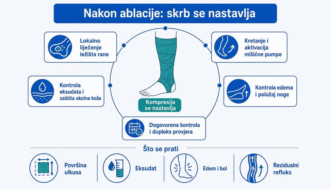 Shema skrbi nakon endovenske ablacije: noga s kompresijskim zavojem u središtu i kartice s lokalnim liječenjem rane, kontrolom eksudata, kretanjem, kontrolom edema i dogovorenom kontrolom, uz prikaz što se prati — površina ulkusa, eksudat, edem i bol te rezidualni refluks.