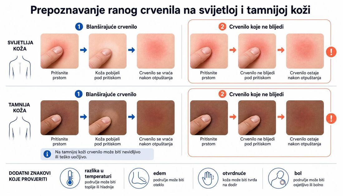 Usporedni prikaz pritiska prstom na svijetloj i tamnijoj koži: crvenilo koje blijedi pod pritiskom i vraća se, nasuprot crvenilu koje ne blijedi, uz napomenu da na tamnijoj koži crvenilo može biti nevidljivo te dodatne znakove razlike u temperaturi, edema, otvrdnuća i boli.
