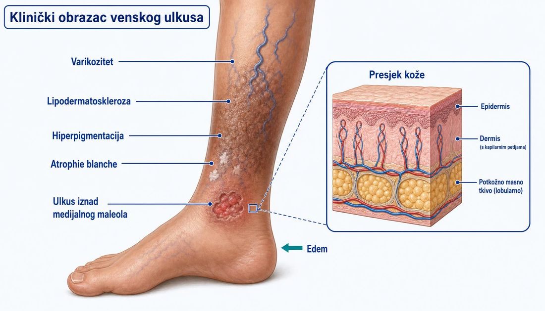Medijalni prikaz potkoljenice s obrascem venskog ulkusa: plitki ulkus iznad medijalnoga maleola, hiperpigmentacija, lipodermatoskleroza, atrophie blanche, varikozitet i edem, uz uvećani presjek kože s epidermisom, dermisom i potkožnim masnim tkivom.