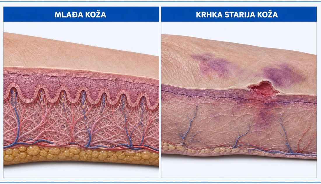 Usporedni anatomski presjek mlađe i krhke starije kože podlaktice: mlađa koža ima deblji epidermis i izražene papile, a starija tanji epidermis, oslabljenu vezu slojeva, krvni podljev i plitku razderotinu.