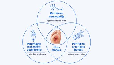 Tri međusobno povezana kruga: periferna neuropatija s izgubljenim zaštitnim osjetom, ponavljano mehaničko opterećenje s vršnim tlakom i brojem koraka te periferna arterijska bolest s otežanom obnovom tkiva; u presjeku je plantarni ulkus stopala.