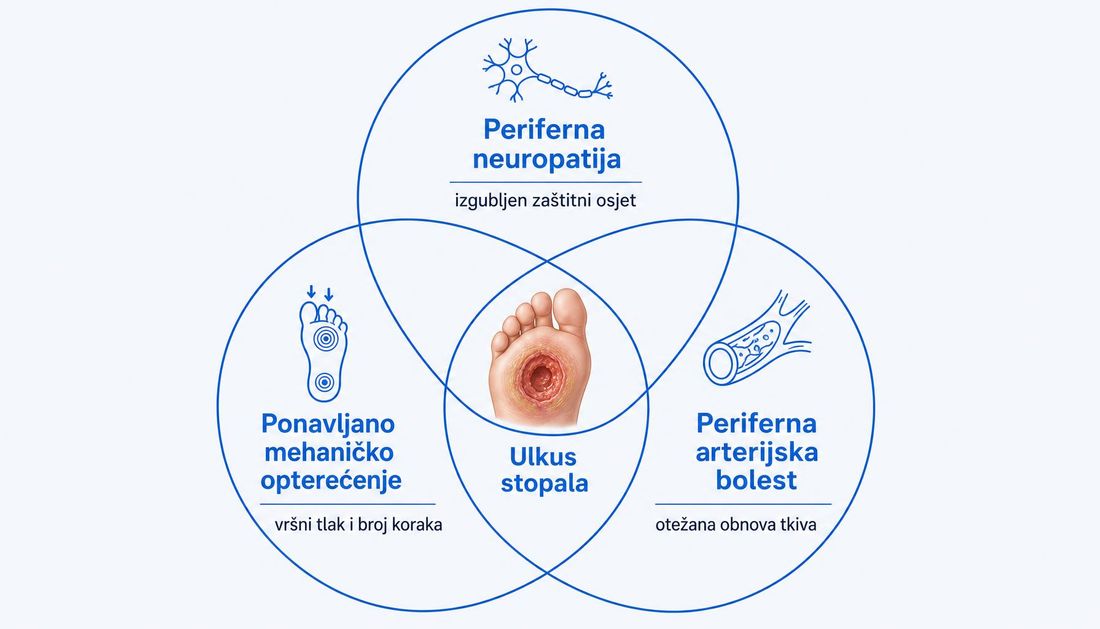 Tri povezana kruga: periferna neuropatija, ponavljano mehaničko opterećenje i periferna arterijska bolest, s ulkusom stopala u presjeku.