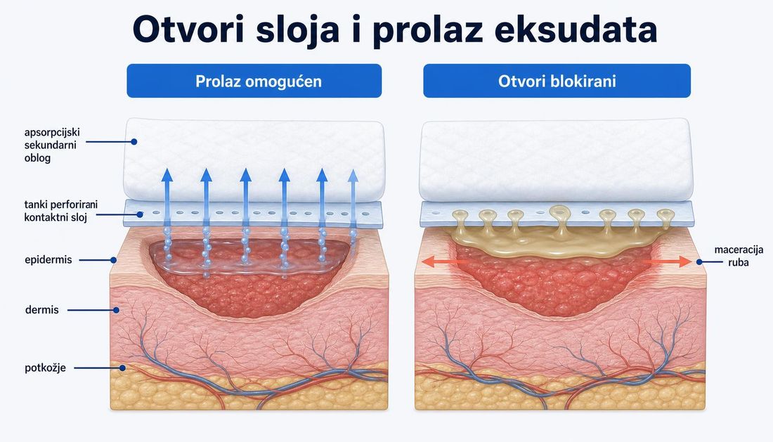 Dva presjeka rane s kontaktnim slojem: lijevo eksudat slobodno prolazi kroz otvore prema sekundarnoj oblozi, desno su otvori blokirani, tekućina se zadržava na ležištu i rub rane je maceriran.