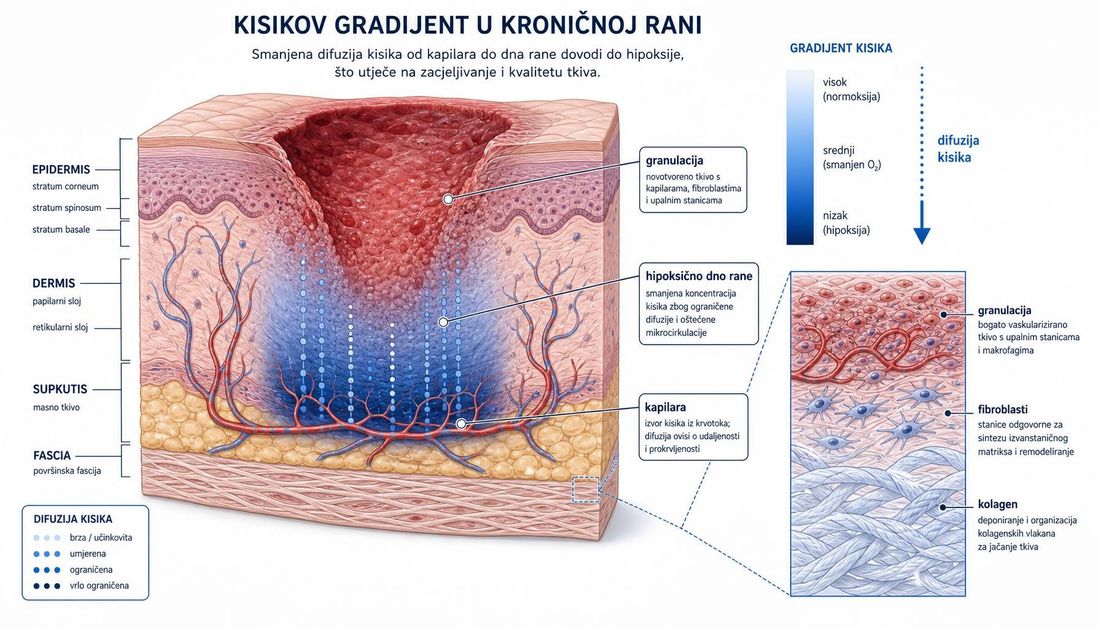 Presjek kože i kronične rane s prikazom kisikova gradijenta: kapilare, hipoksično dno rane, granulacija i odlaganje kolagena.