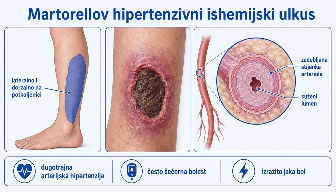 Prikaz Martorellova hipertenzivnog ishemijskog ulkusa: shema potkoljenice s osjenčanim lateralnim i dorzalnim područjem, izgled rane s tamnim ležištem i živo crvenoljubičastim rubom te presjek arteriole sa zadebljanom stijenkom i suženim lumenom, uz oznake dugotrajne hipertenzije, šećerne bolesti i izrazito jake boli.