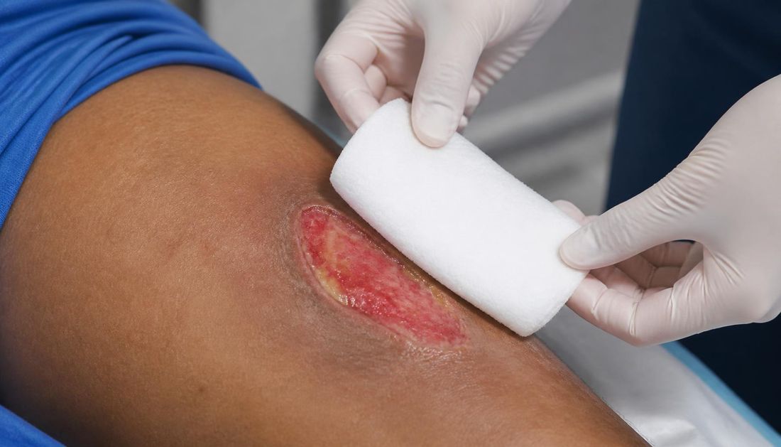 A superabsorbent dressing applied to a wound with moderate or heavy exudate