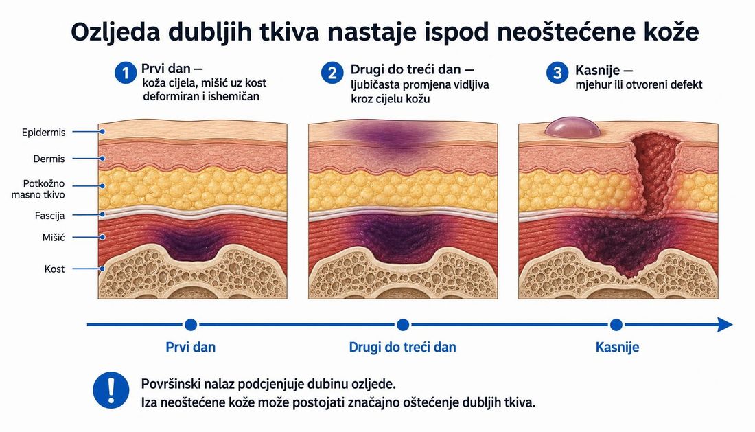 Presjek tkiva iznad križne kosti s prikazom oštećenja koje započinje u mišiću i potkožju ispod naizgled neoštećene kože, s tamnoljubičastom promjenom na površini.