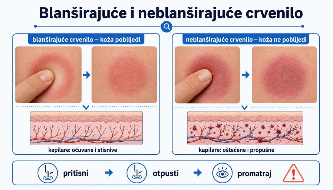Usporedni prikaz blanširajućeg crvenila koje pod pritiskom prsta poblijedi i neblanširajućeg crvenila koje ne poblijedi, s presjekom kapilara.