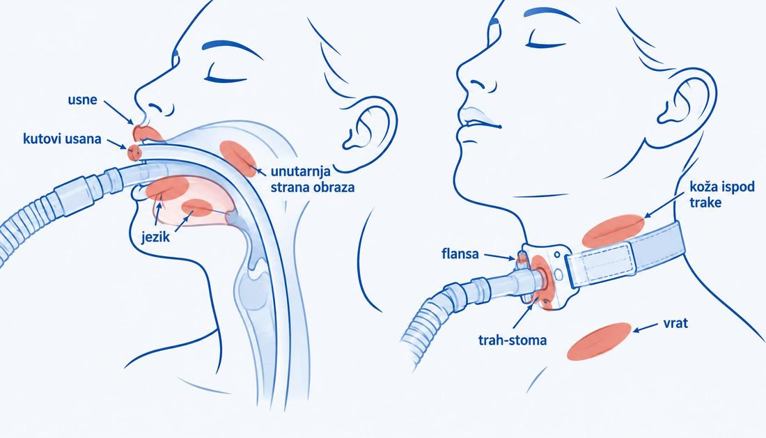 Shema endotrahealnog tubusa i traheostome s označenim mjestima pritiska: usne, kutovi usana, jezik, obrazi, brada, ogrlica traheostome i koža ispod vezica.
