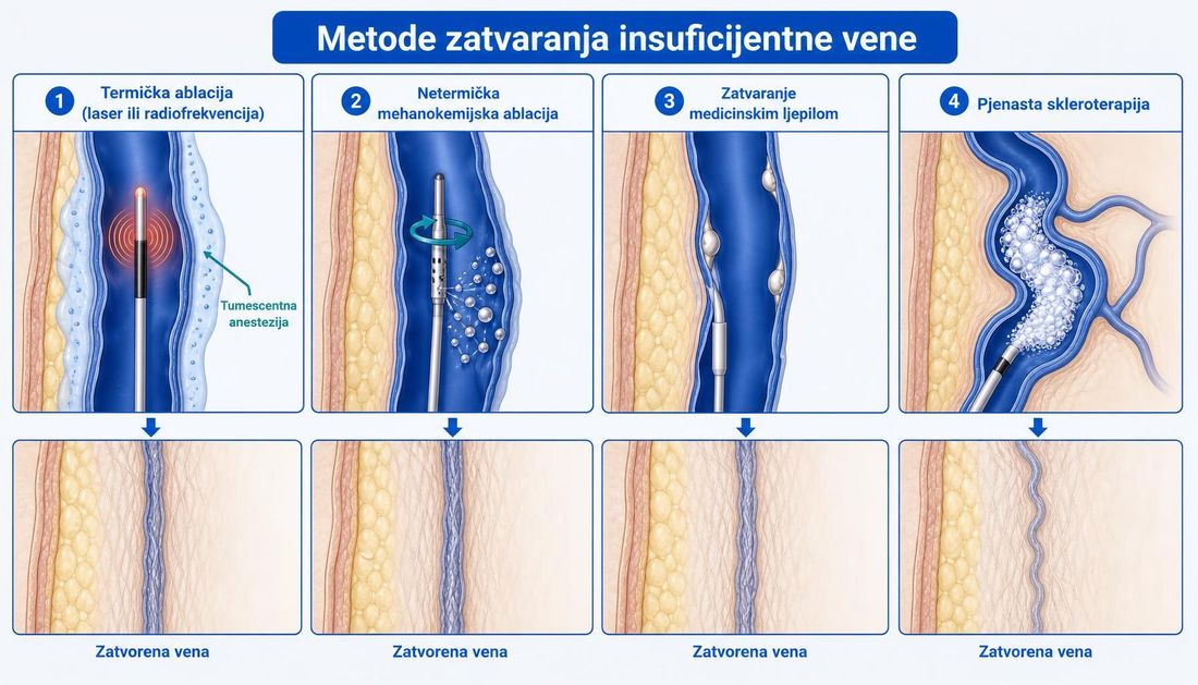 Shema četiriju metoda zatvaranja insuficijentne vene: termička ablacija uz tumescentnu anesteziju, netermička mehanokemijska ablacija, zatvaranje medicinskim ljepilom i pjenasta skleroterapija, svaka s prikazom zatvorene vene nakon postupka.