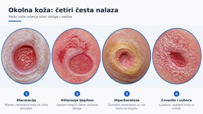 Četiri povećana prikaza okolne kože: maceracija, oštećenje nakon skidanja ljepljive obloge, žućkasta hiperkeratoza uz rub te crvenilo sa suhom ljuskavom kožom.