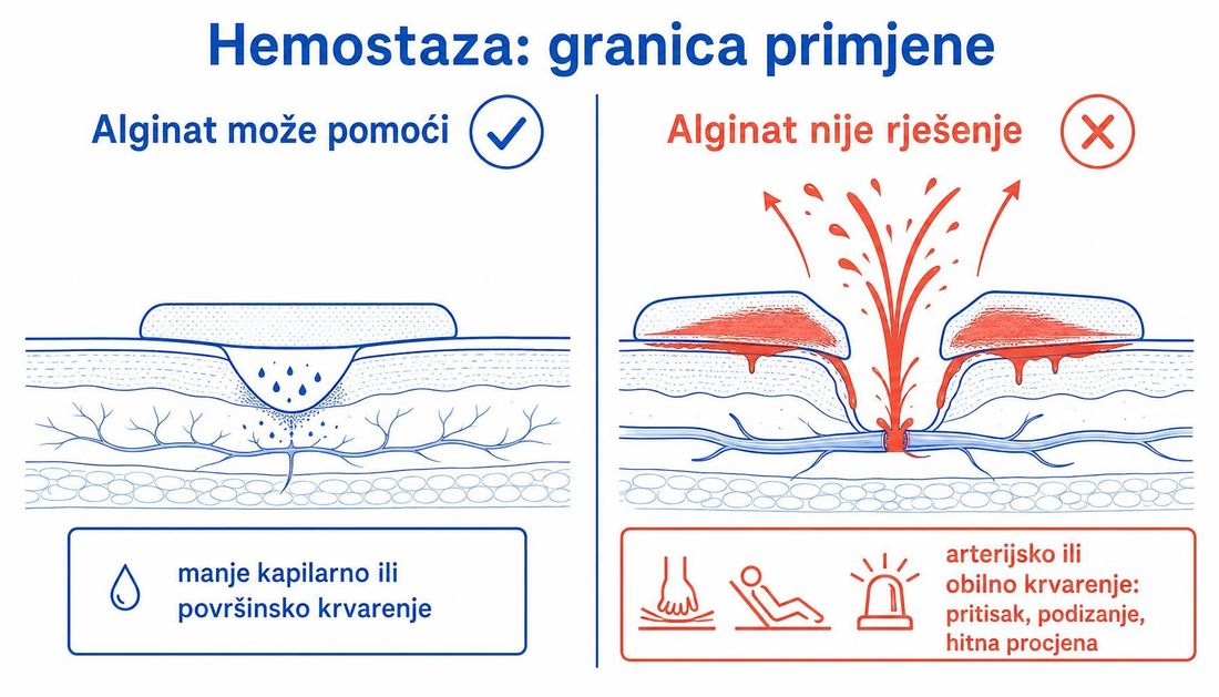Shema granice primjene: alginat kod manjeg kapilarnog krvarenja i neprimjerenost kod arterijskog krvarenja