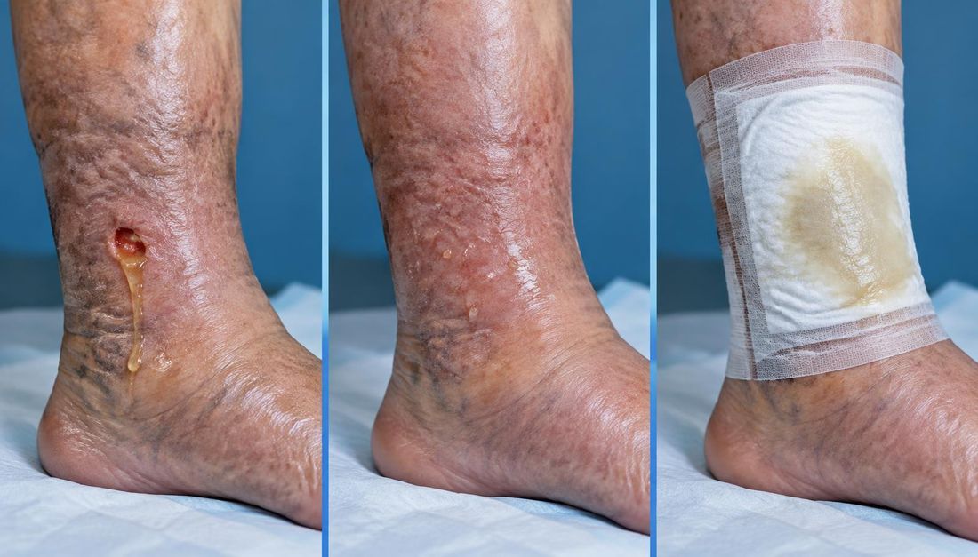 Comparison of wound exudate, droplets of lymphorrhoea through the skin and a saturated dressing