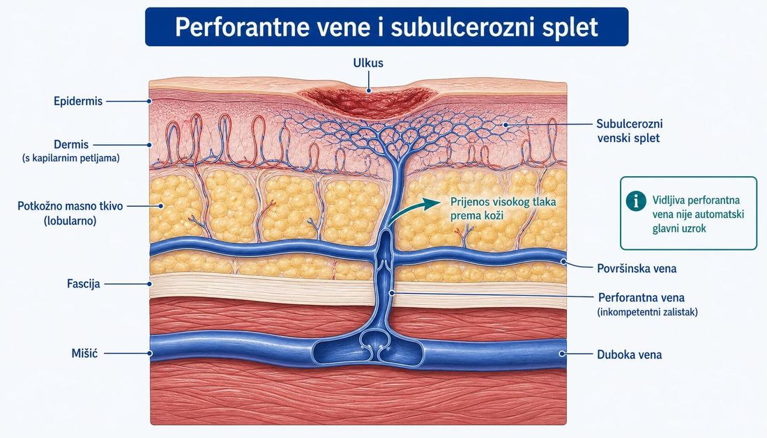 Presjek medijalne potkoljenice: epidermis, dermis s kapilarnim petljama, lobularno potkožno masno tkivo, fascija i mišić, s površinskom venom, dubokom venom i insuficijentnom perforantnom venom koja prenosi visoki tlak prema koži te subulceroznim venskim spletom ispod ulkusa.