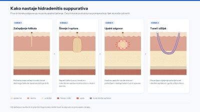 Presjek kože u četiri koraka: začepljenje folikula, širenje i ruptura folikula, upalni odgovor u dermisu te nastanak epiteliziranoga tunela s ožiljkom