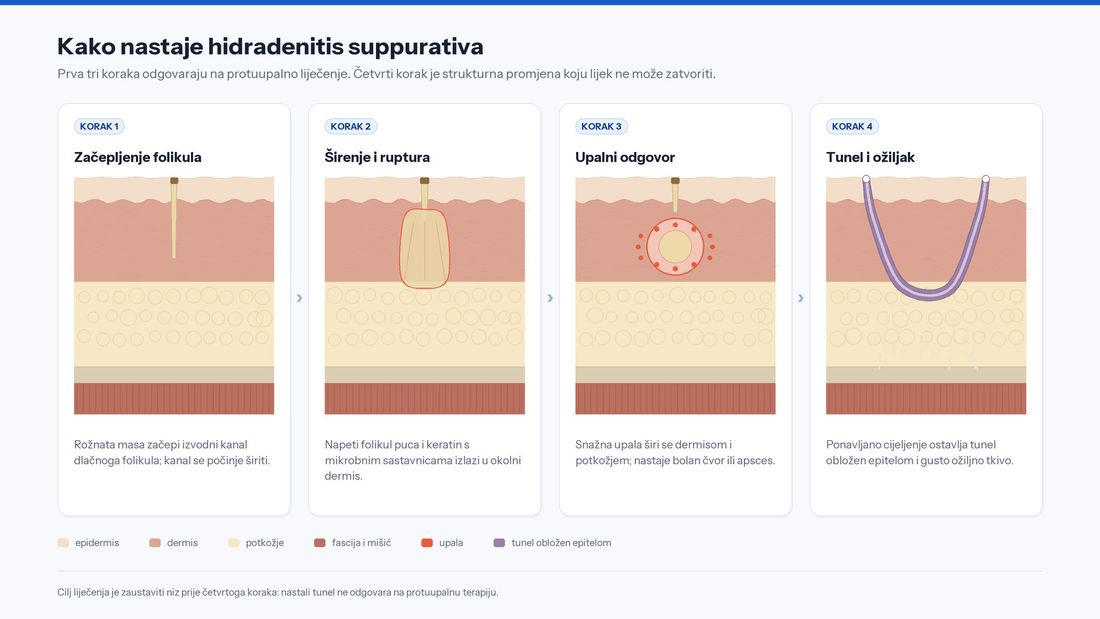Presjek kože u četiri koraka: začepljenje folikula, širenje i ruptura folikula, upalni odgovor u dermisu te nastanak epiteliziranoga tunela s ožiljkom
