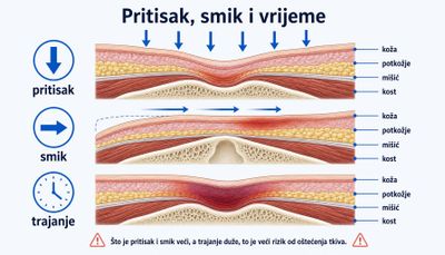 Shema u tri sloja prikazuje kako pritisak, smik i trajanje djeluju na kožu, potkožje, mišić i kost nad koštanom izbočinom.