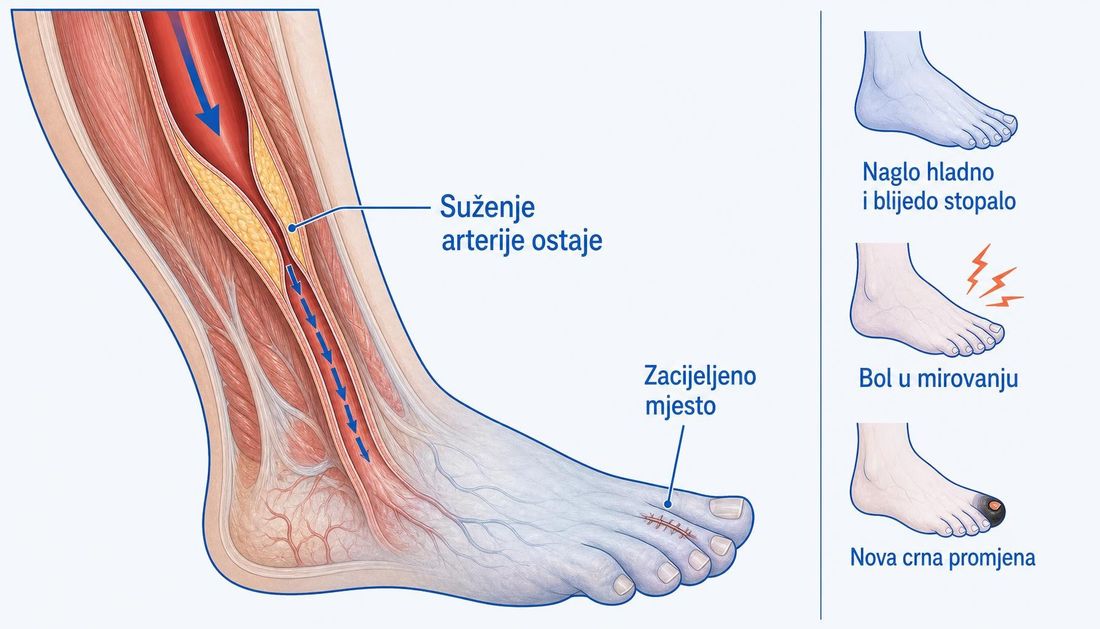Uzdužni presjek arterije potkoljenice sa suženjem zbog aterosklerotskoga plaka i sve tanjim strelicama protoka prema stopalu koje je blijedo i sivkasto, uz zacijeljeni ožiljak na prstu; desno su tri prikaza znakova pogoršanja: naglo hladno i blijedo stopalo, bol u mirovanju i nova crna promjena.